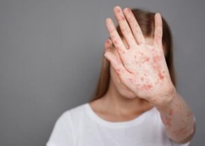 В Україні зафіксували до 1,2 тис. випадків кору з початку року